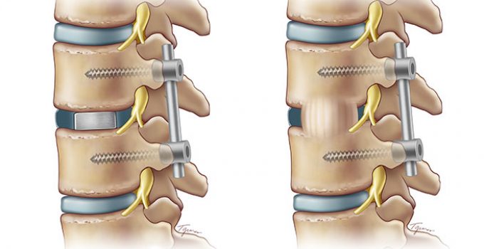 When is Spinal Surgery Necessary