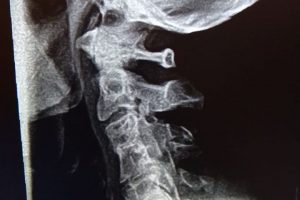 xray, Escondido Chiropractor, Neck pan, Congenital fusion