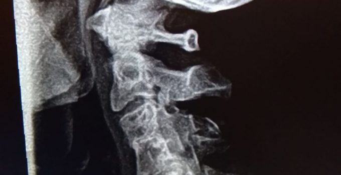 xray, Escondido Chiropractor, Neck pan, Congenital fusion