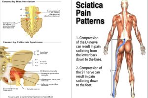 When Sciatica Needs Spinal Decompression Instead of Physical Therapy